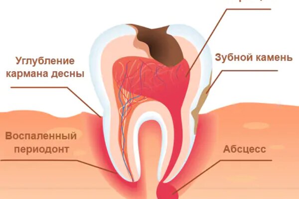 Лечение кисты зуба